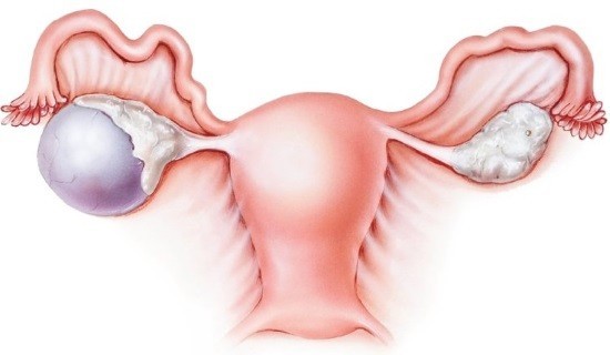 Киста эндометриоидная яичника лапароскопия thumbnail