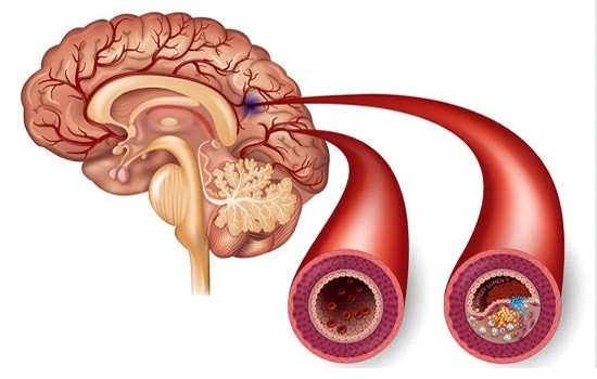 Атеросклероз сосудов головного мозга