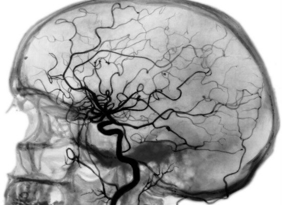 Ангиография сосудов головного мозга