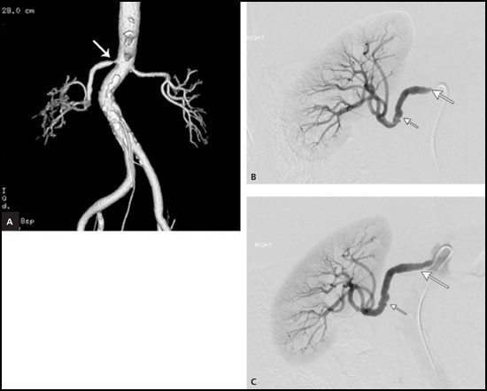 Снимки, полученные при проведении ангиографии почек