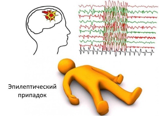 Эпилептиформная активность у ребенка 5 лет thumbnail